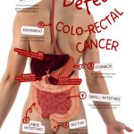 Colorectal Cancer Holistic Medicine Kindle Book English-0